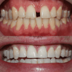 Before and after Invisalign Treatment